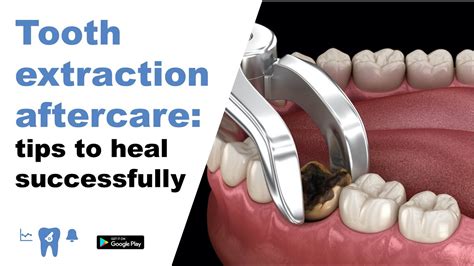 The <b>extraction</b> site takes about 4-6 months to heal completely. . Can you go to sauna after tooth extraction